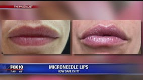 Microneedle procedure for lips