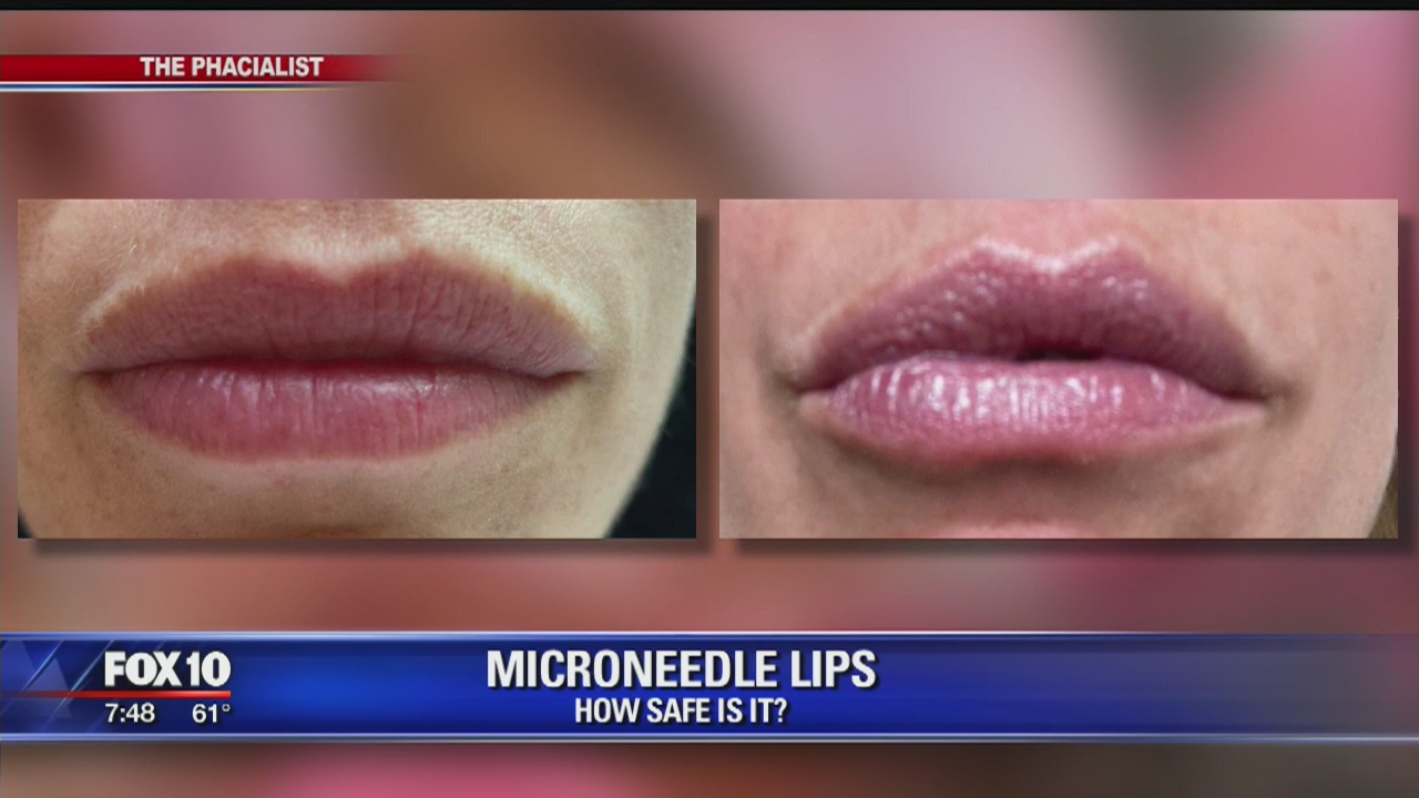 Microneedle procedure for lips