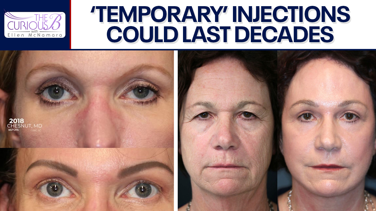 The truth about facial fillers | The Curious B