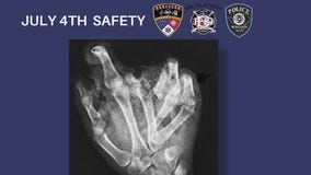 Doctors send warning ahead of 4th of July fun