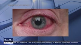 Latest COVID-19 variant causing pink eye