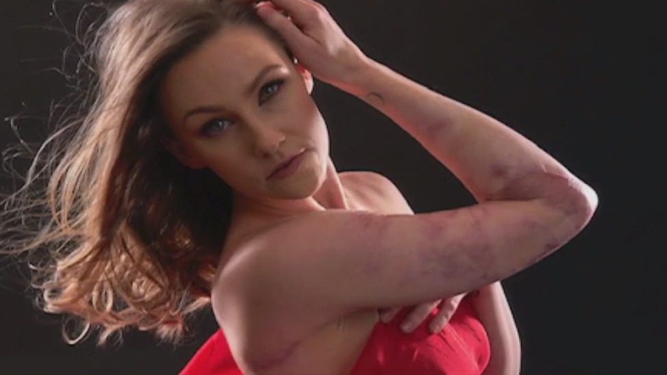 Waukesha woman set on fire by stranger thriving 2 years after attack