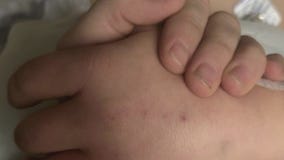 Wisconsin boy recovers after ATV crash