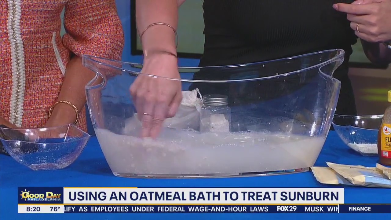 Household items you can use to treat sunburn