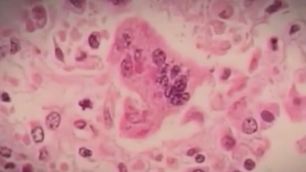 Measles outbreak in Texas, 1 child dies