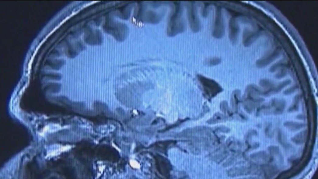 Pushing for blood tests for Alzheimer's