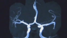 Health Watch: Blood test could rule out Alzheimer's