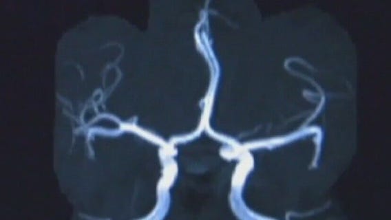 Health Watch: Blood test could rule out Alzheimer's