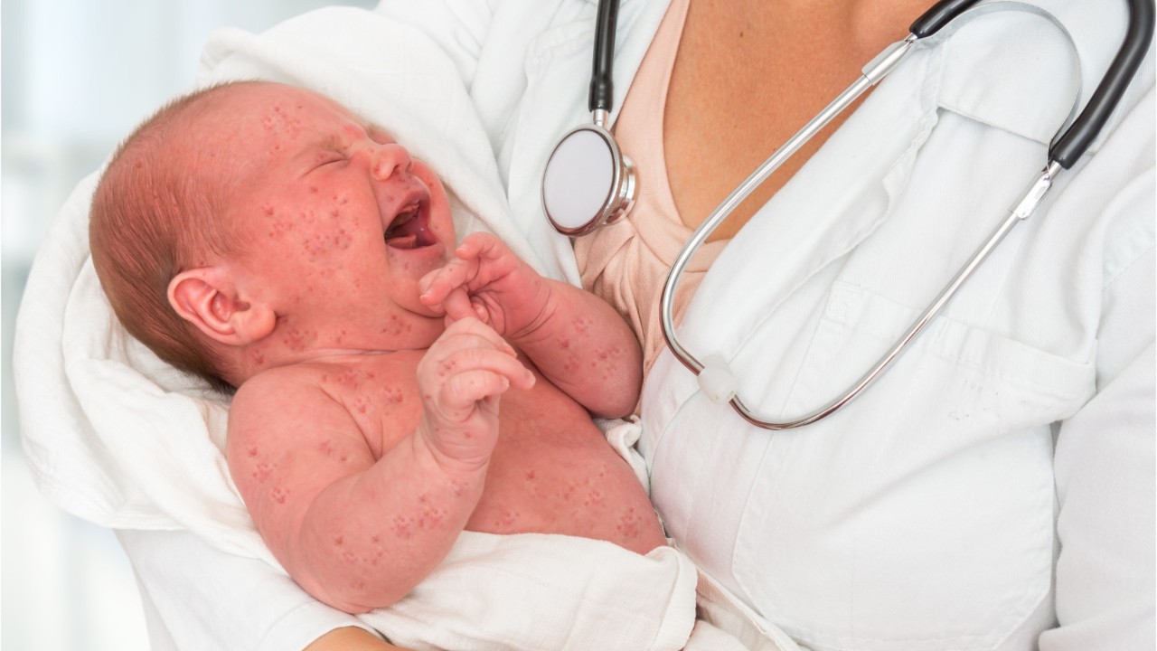 Measles virus suppresses the immune system for years after infection, study finds