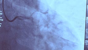 New research suggests virus may leave lingering heart damage