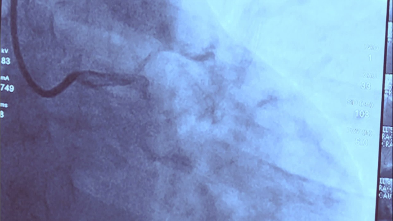 New research suggests virus may leave lingering heart damage