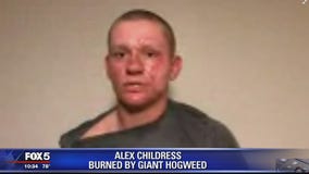 Giant hogweed sends Virginia teen to hospital, burn unit