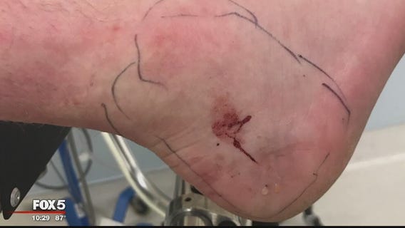 Man bitten by copperhead snake at Lake Needwood