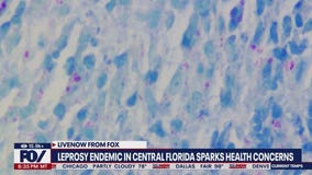 Leprosy considered an 'endemic' in Central Florida