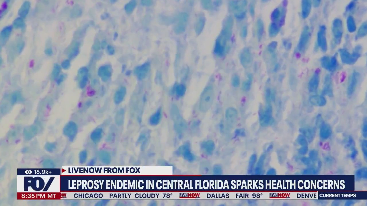 Leprosy considered an 'endemic' in Central Florida