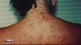Sea lice being reported in Ocean City, officials say