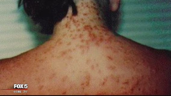 Officials warn of sea lice in Ocean City