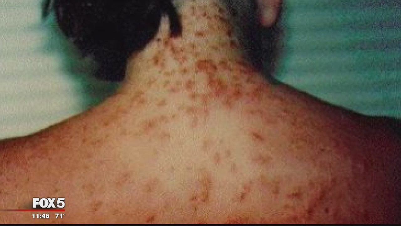 Officials warn of sea lice in Ocean City