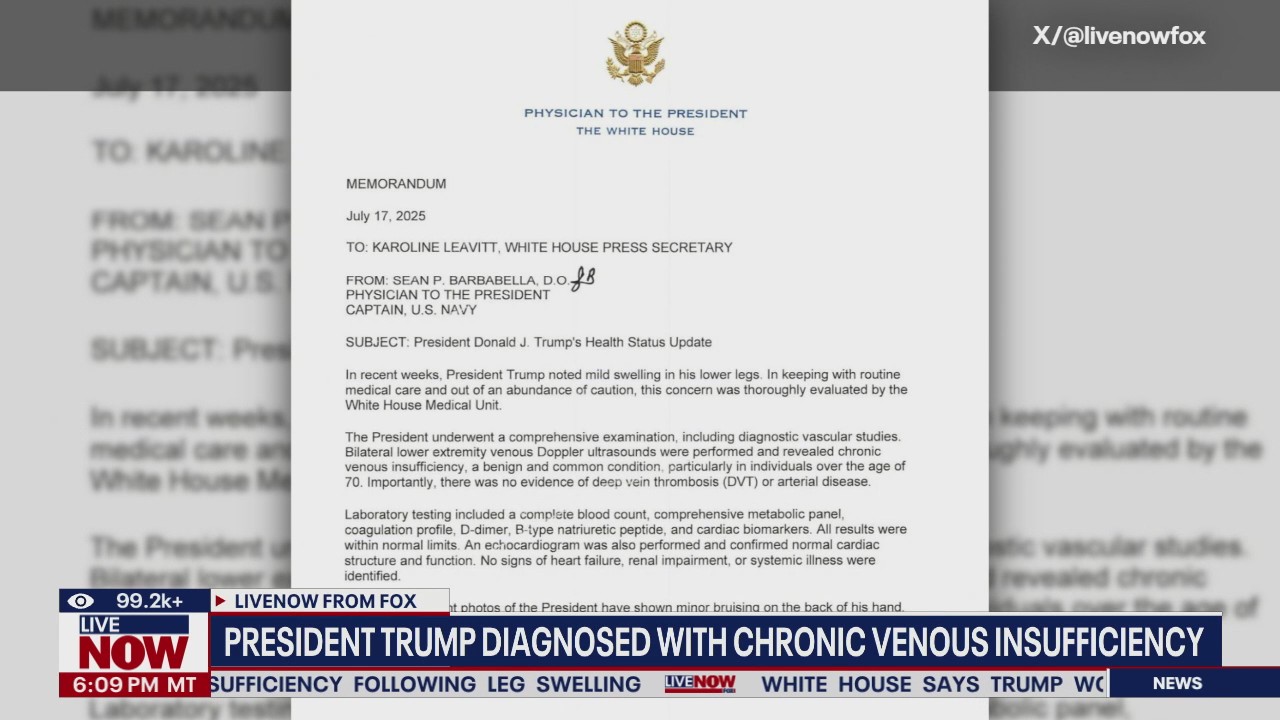 Trump diagnosed with chronic venous insufficiency