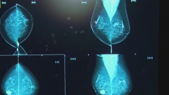 Preventing painful side effect of lymph node removal