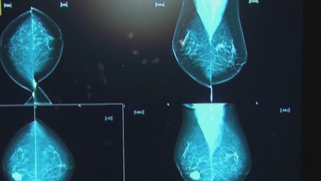 Preventing painful side effect of lymph node removal