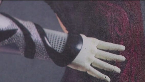 Florida company makes customizable bionic limbs