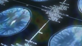 Alzheimer's drug Leqembi could help families