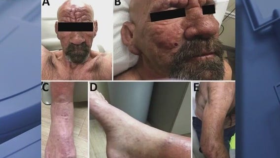 Leprosy an 'endemic' to Central Florida: CDC