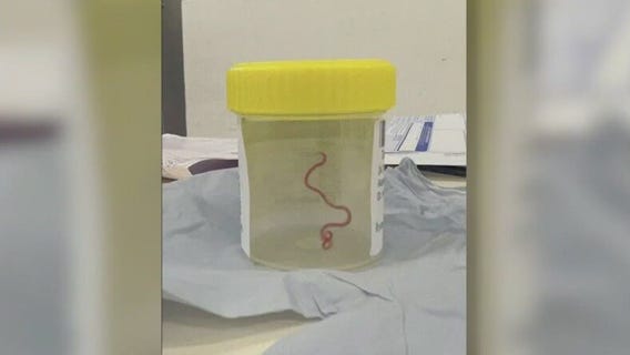 Worm plucked from woman?s brain