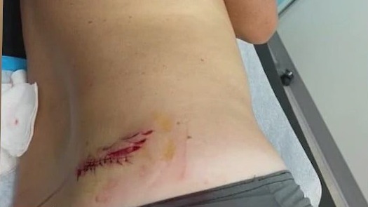 2 shark bites in 24 hours in Florida