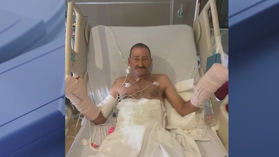 Florida man loses fingers in fireworks explosion