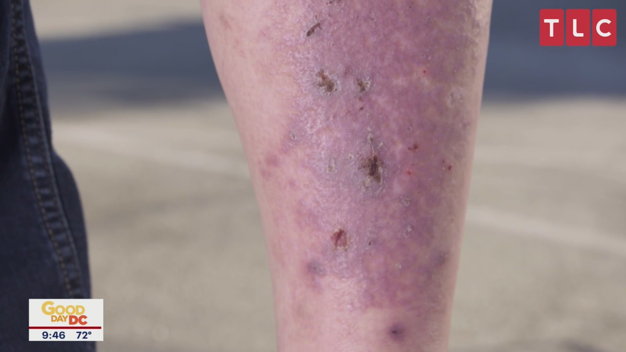 Dr. Pimple Popper talks new season of TLC show