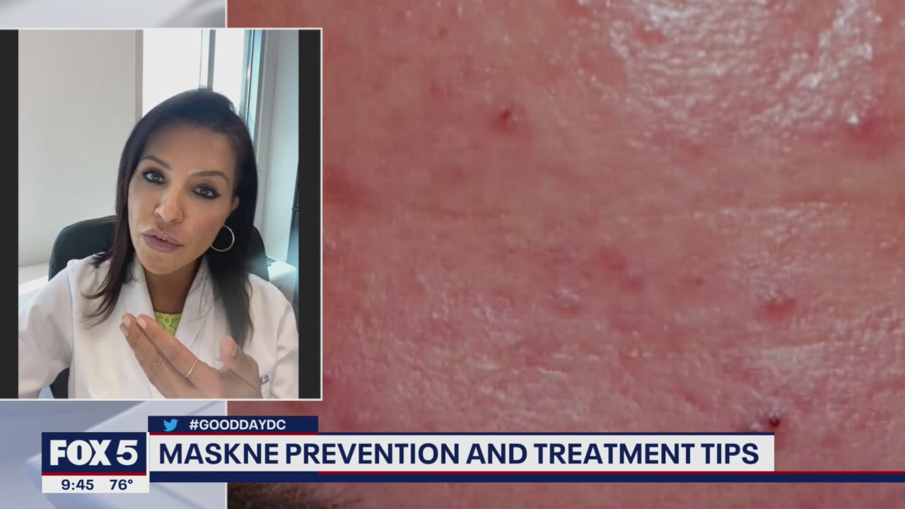 MASKNE PREVENTION: Dealing with acne caused by wearing a mask