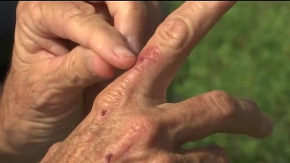 Protecting yourself from flesh-eating bacteria