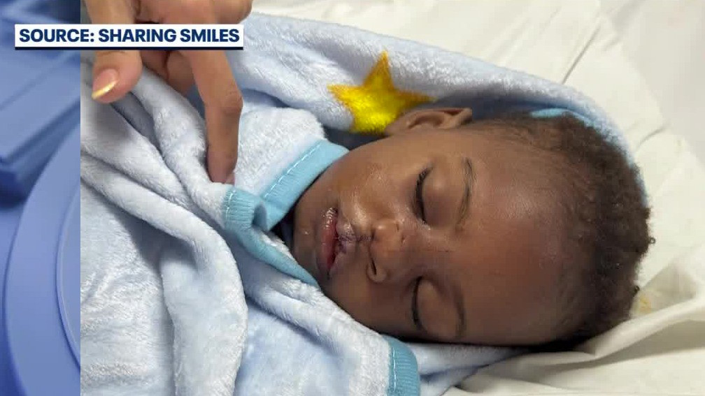 'Sharing Smiles' helps kids with cleft palates