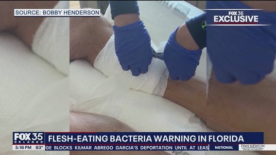 Flesh-eating bacteria cases in Florida on the rise