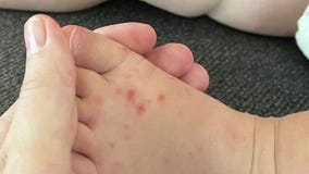 Hand, foot and mouth disease is going around