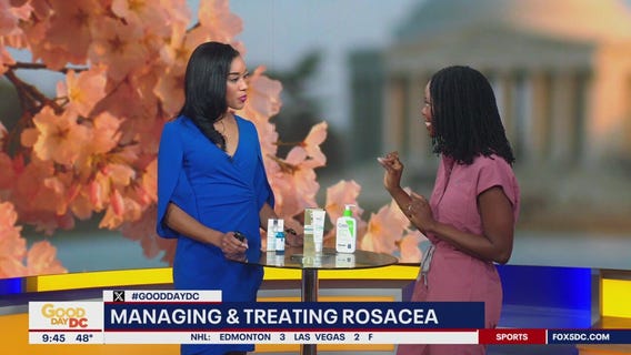 Managing and treating roscea