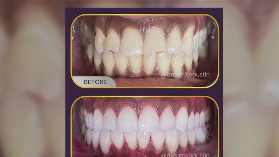 Veneers: A quick way to a perfect smile
