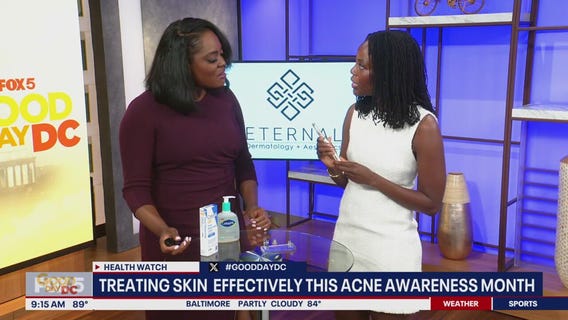 Treating skin effectively this Acne Awareness Month