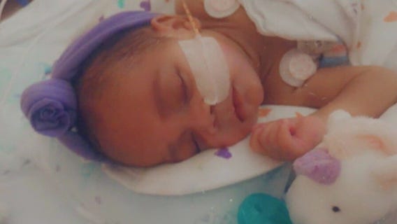 Preemie infant twin overcomes open heart surgery