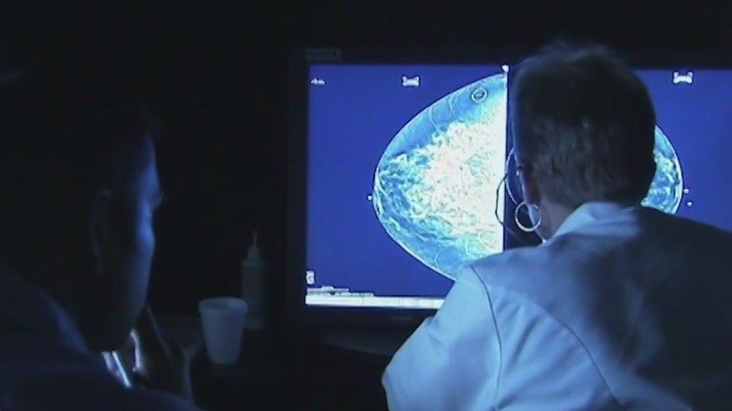 Experts now say mammograms should start at 40