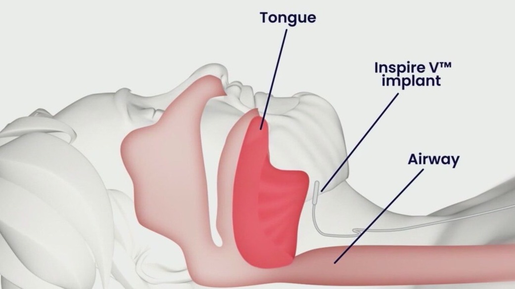 Implant could treat sleep apnea without CPAP