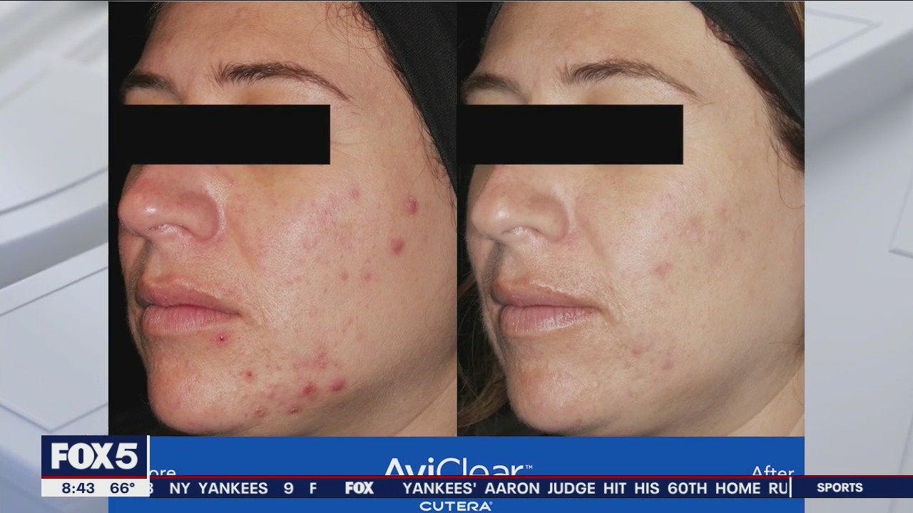 New tools to treat skin