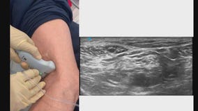 Treating pain with nerve block procedures