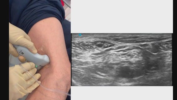 Treating pain with nerve block procedures