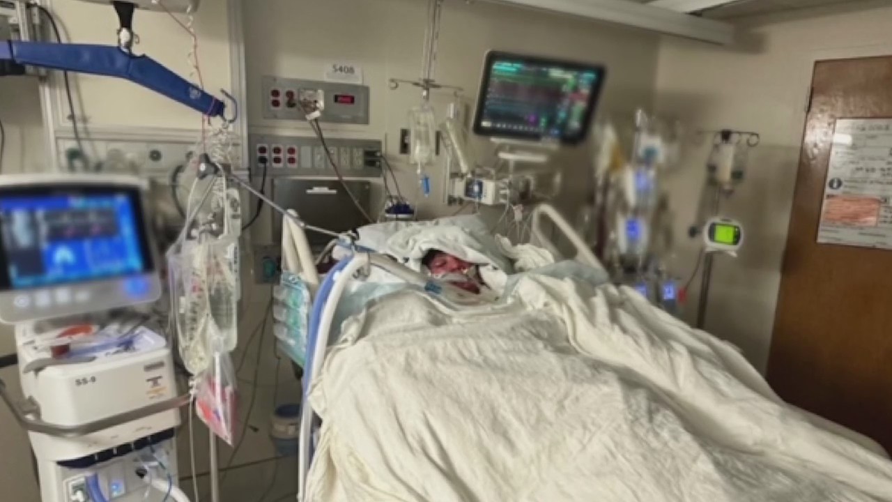 TikTok 'Flamethrower' challenge puts teen in hospital with burns to over 70% of his body