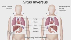 Chicago surgeons perform successful transplants on patients with 'flipped organs'