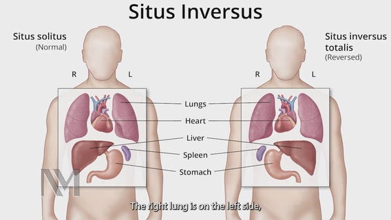 Chicago surgeons perform successful transplants on patients with 'flipped organs'