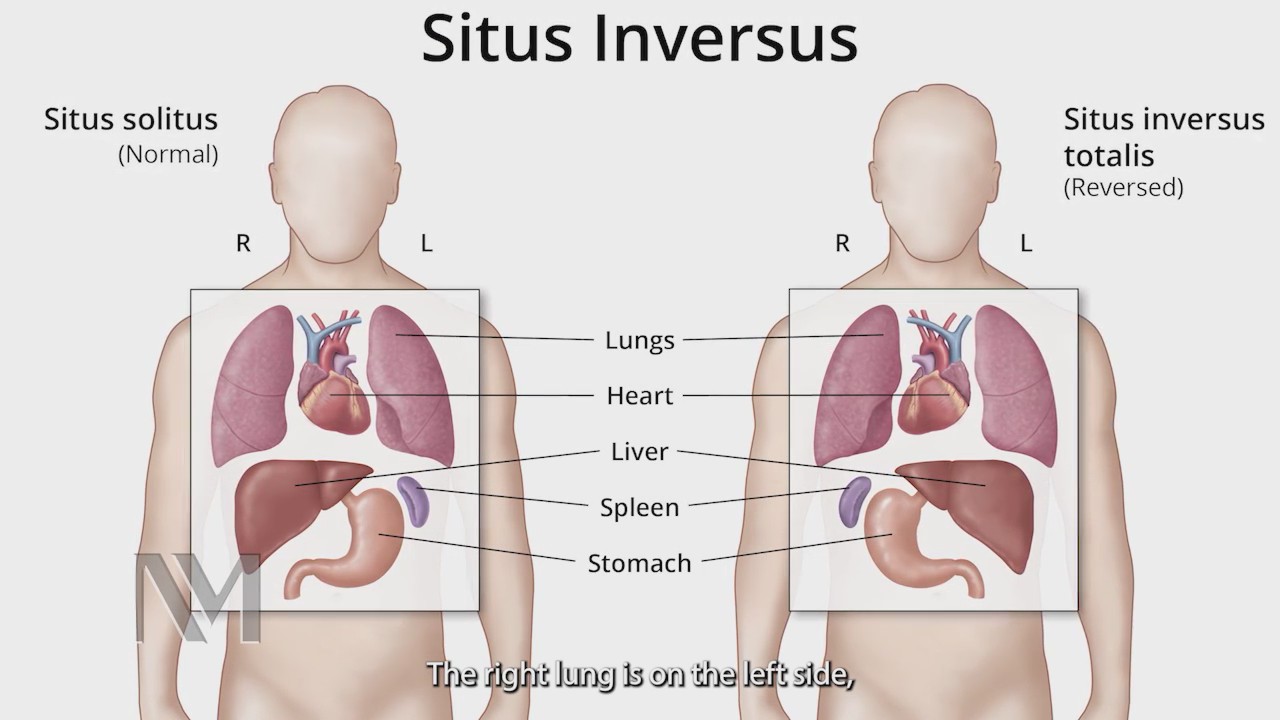 Chicago surgeons perform successful transplants on patients with 'flipped organs'